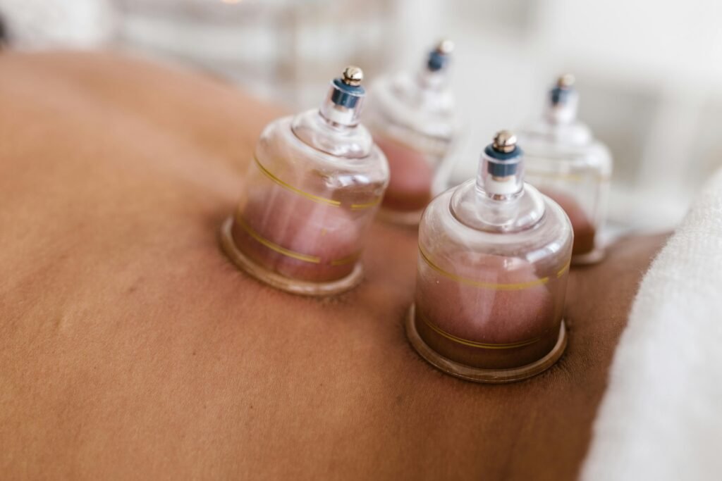 हिजामा, حجامہ, Hijama